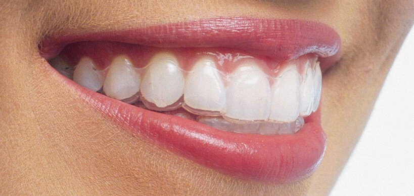 invisalign the clear alternative to braces